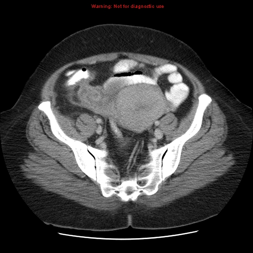 Acute appendicitis complicated by ovarian vein thrombophlebitis (Radiopaedia 16172-15851 Axial C+ portal venous phase 72).jpg