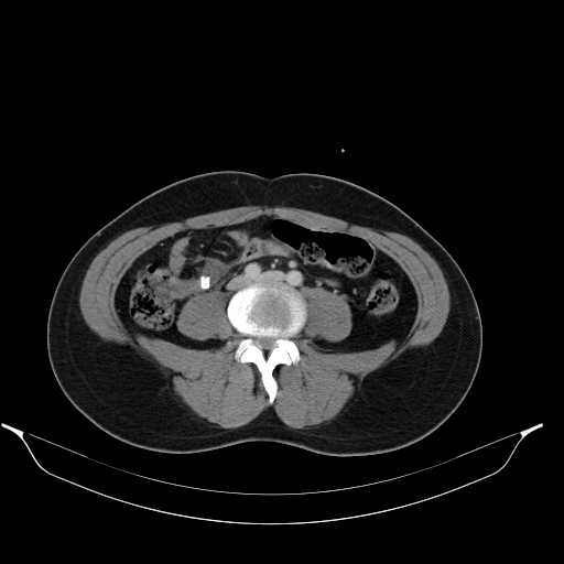 File:Acute appendicitis with appendicoliths (Radiopaedia 21148-21062 Axial C+ portal venous phase 6).jpg