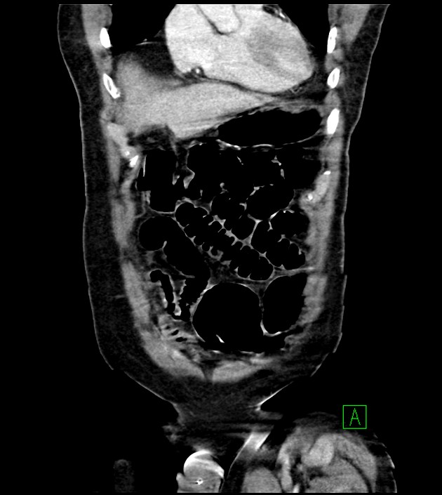 Acute arterial mesenteric ischemia (Radiopaedia 78238-90828 Coronal C+ portal venous phase 25).jpg