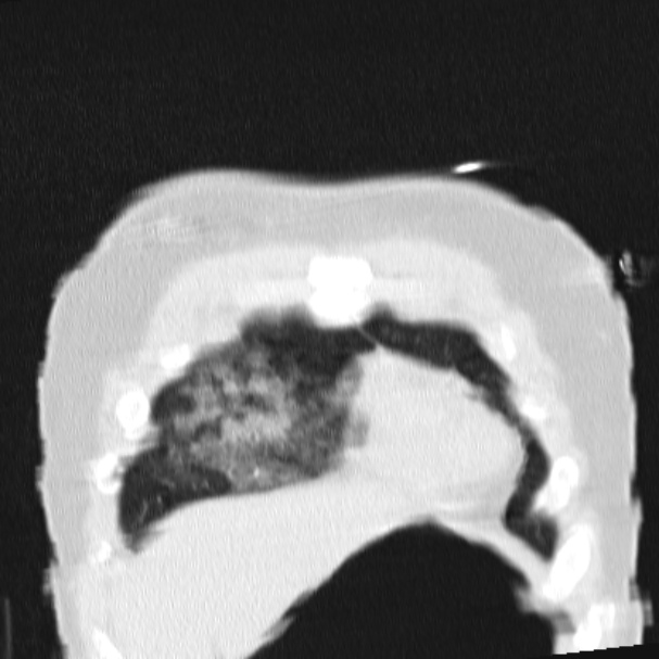 Acute aspiration pneumonitis (Radiopaedia 33605-34703 Coronal lung window 16).jpg