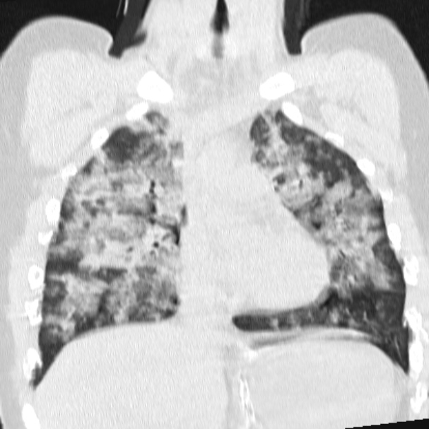 Acute aspiration pneumonitis (Radiopaedia 33605-34703 Coronal lung window 38).jpg