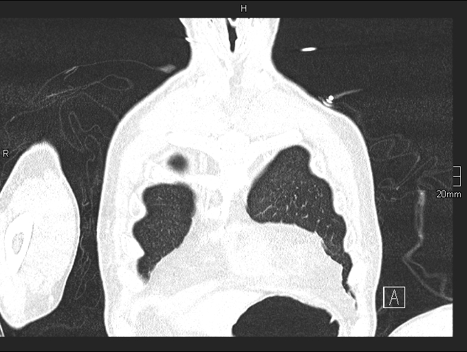 File:Acute aspiration pneumonitis (Radiopaedia 55642-62166 Coronal lung window 12).jpg