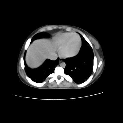 File:Acute calculous cholecystitis in patient with osteopetrosis (Radiopaedia 77871-90159 Axial C+ delayed 2).jpg