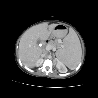 Acute calculous cholecystitis in patient with osteopetrosis (Radiopaedia 77871-90159 Axial C+ portal venous phase 32).jpg