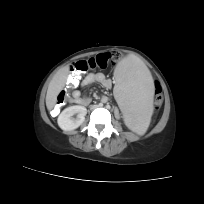 File:Acute calculous cholecystitis in patient with osteopetrosis (Radiopaedia 77871-90159 Axial C+ portal venous phase 49).jpg