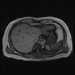 File:Acute cholecystitis (Radiopaedia 72392-82923 Axial T1 out-of-phase 29).jpg