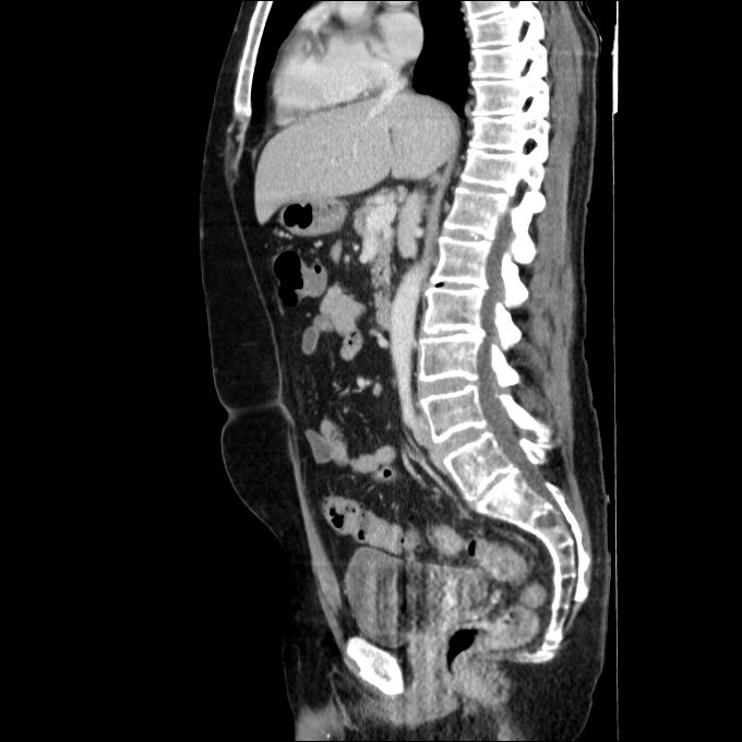 Acute cholecystitis and incidental left sided IVC (Radiopaedia 49352-54459 Sagittal C+ portal venous phase 48).jpg