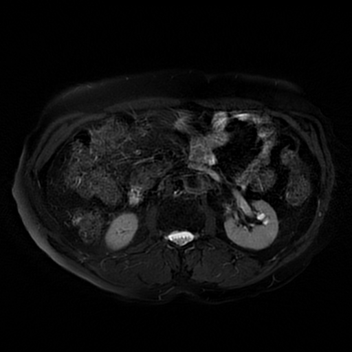 File:Acute cholecystitis complicated by pylephlebitis (Radiopaedia 65782-74915 Axial T2 fat sat 31).jpg