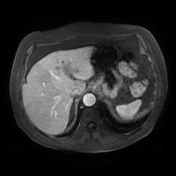 File:Acute cholecystitis complicated by pylephlebitis (Radiopaedia 65782-74915 Axial arterioportal phase T1 C+ fat sat 28).jpg