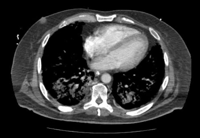 Acute cor pulmonale (ultrasound) (Radiopaedia 83508-98818 Axial C+ CTPA 52).jpg