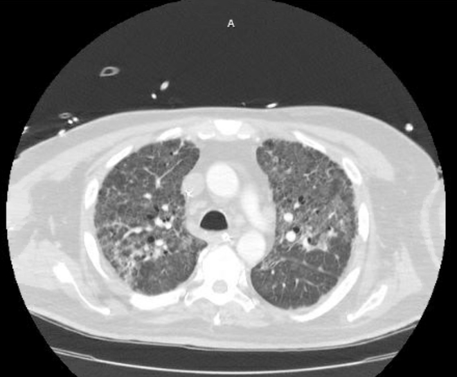 Acute cor pulmonale (ultrasound) (Radiopaedia 83508-98818 Axial lung window 31).jpg