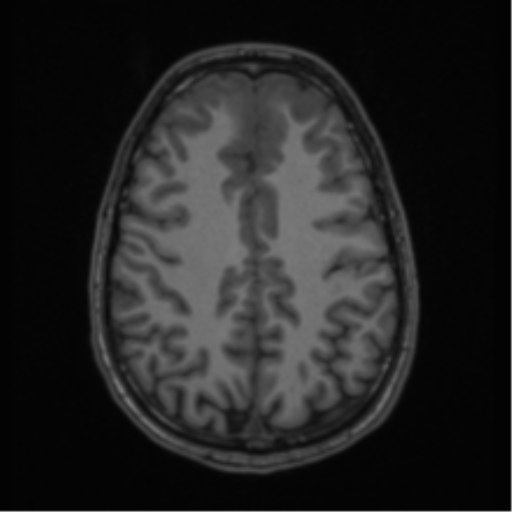 Acute disseminated encephalomyelitis (ADEM) (Radiopaedia 65319-74349 Axial T1 48).png