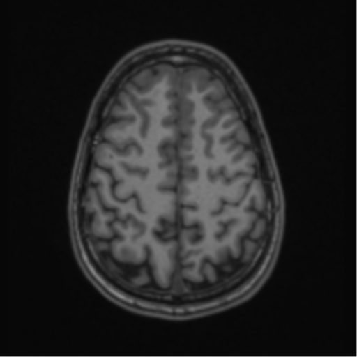 Acute disseminated encephalomyelitis (ADEM) (Radiopaedia 65319-74349 Axial T1 53).png