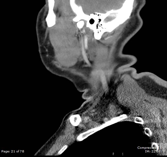 File:Acute epiglottitis (Radiopaedia 54375-60590 Sagittal C+ arterial phase 21).jpg