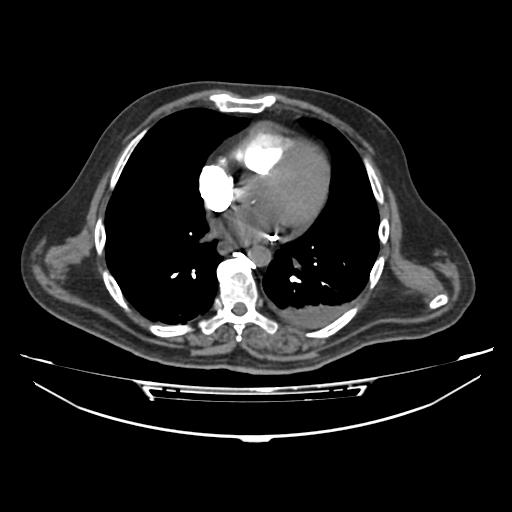 File:Acute heart failure (CT) (Radiopaedia 79835-93075 Axial C+ arterial phase 26).jpg