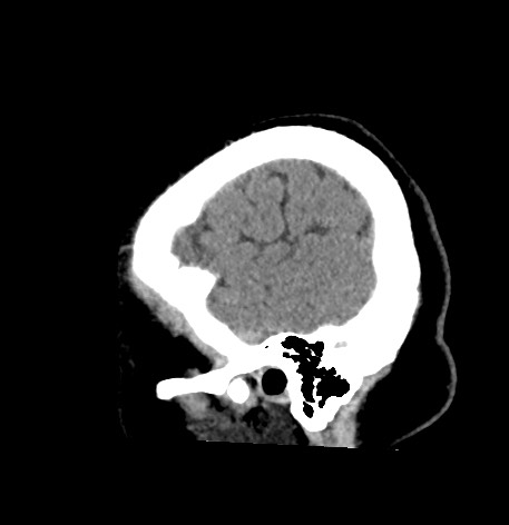 Acute internal carotid artery dissection (Radiopaedia 53541-59558 Sagittal non-contrast 56).jpg