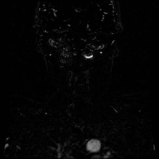Acute internal carotid artery dissection (Radiopaedia 53541-59632 Coronal MRA 15).jpg