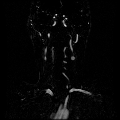 Acute internal carotid artery dissection (Radiopaedia 53541-59632 Coronal MRA 50).jpg
