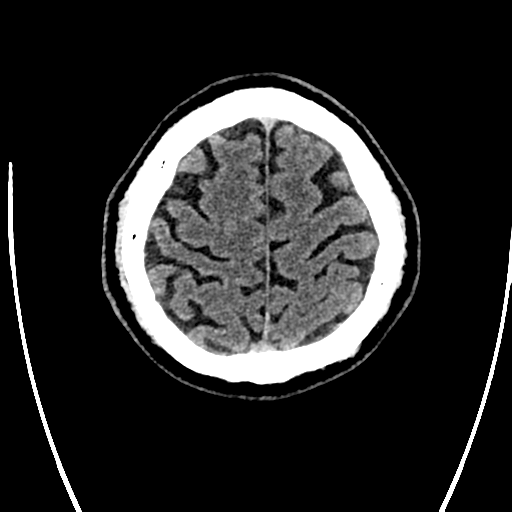 Acute left middle cerebral artery territory ischemic stroke (Radiopaedia 35688-37223 Axial non-contrast 72).png