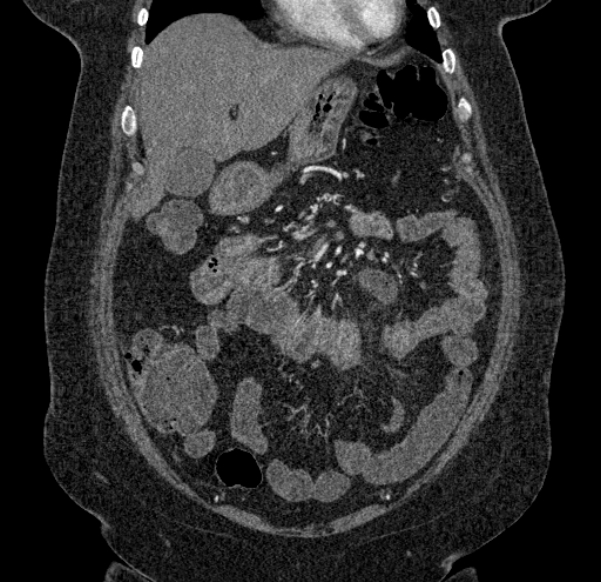 Acute mesenteric ischemia (Radiopaedia 80029-93316 Coronal C+ arterial phase 36).jpg