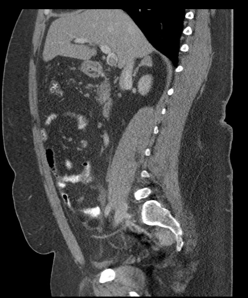 Acute mesenteric venous ischemia (Radiopaedia 46041-50383 Sagittal C+ portal venous phase 47).jpg