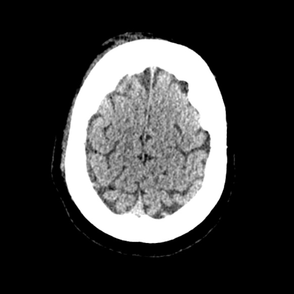 Acute middle cerebral artery territory infarct (Radiopaedia 52380-58283 Axial non-contrast 91).jpg