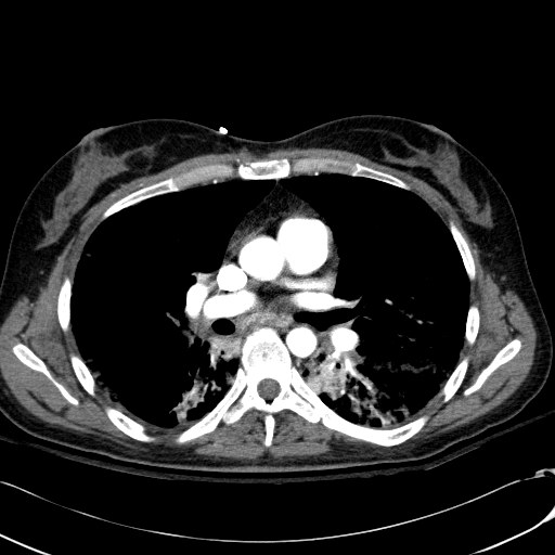 Acute myocardial infarction in CT (Radiopaedia 39947-42415 Axial C+ arterial phase 64).jpg