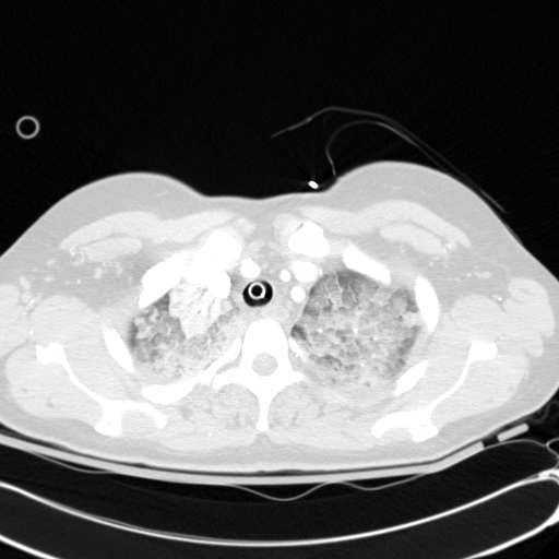 Acute myocardial infarction in CT (Radiopaedia 39947-42415 Axial lung window 18).jpg