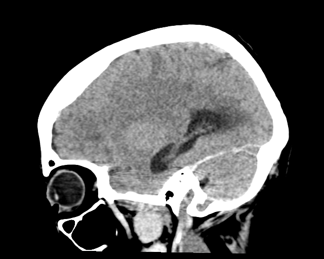 Acute on chronic subdural hemorrhage (Radiopaedia 85330-100923 Sagittal non-contrast 24).jpg