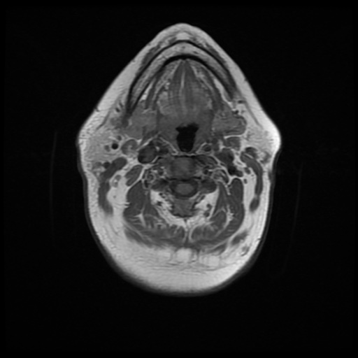 File:Acute otitis externa (Radiopaedia 57296-64236 Axial T1 18).jpg