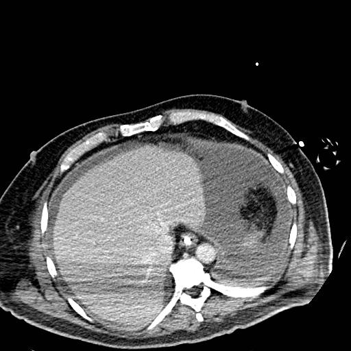 File:Acute pancreatic necrosis (Radiopaedia 13560-18501 Axial C+ portal venous phase 11).jpg