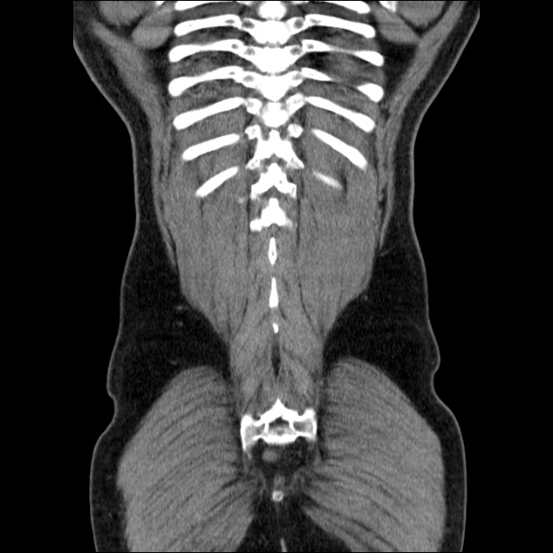 Acute pancreatitis (Radiopaedia 26663-26813 Coronal C+ portal venous phase 56).jpg