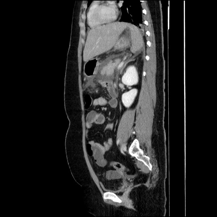 Acute pancreatitis (Radiopaedia 69236-79012 Sagittal C+ portal venous phase 43).jpg