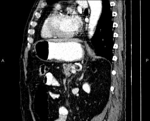 Acute pancreatitis (Radiopaedia 85146-100701 Sagittal C+ portal venous phase 61).jpg