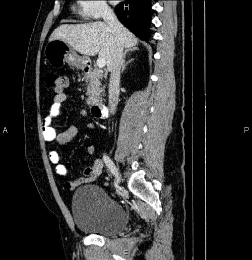 File:Acute pancreatitis (Radiopaedia 85390-101010 Sagittal C+ portal venous phase 41).jpg