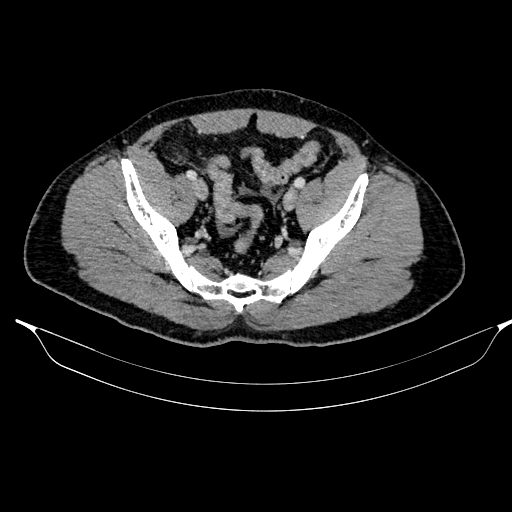 Acute pancreatitis (Radiopaedia 87428-103757 Axial C+ portal venous phase 82).jpg