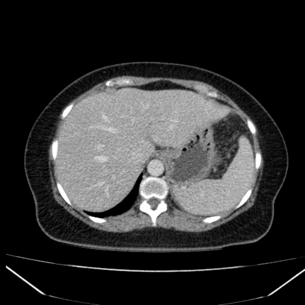 Acute pancreatitis - Balthazar C (Radiopaedia 26569-26714 Axial C+ portal venous phase 26).jpg