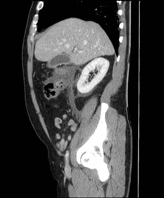 Acute pancreatitis - Balthazar E (Radiopaedia 23080-23110 Sagittal C+ portal venous phase 25).jpg