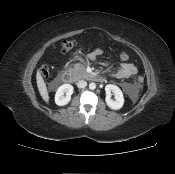 File:Acute pancreatitis - Balthazar E (Radiopaedia 29016-29377 Axial C+ portal venous phase 31).png