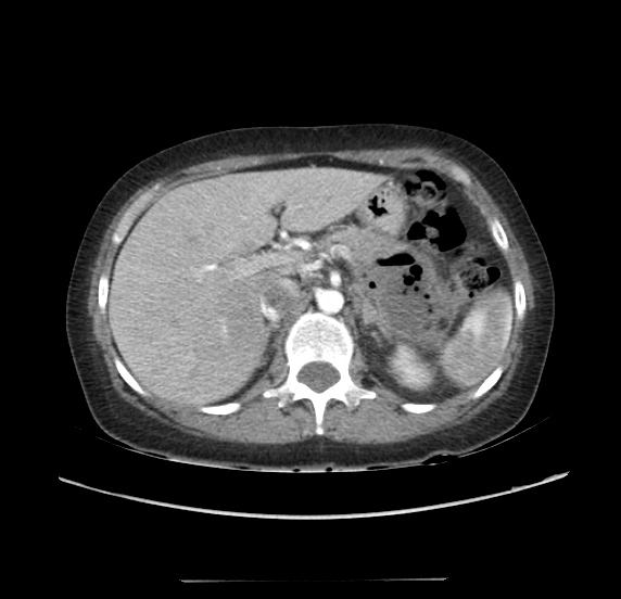 File:Acute pancreatitis - Balthazar E - post ERCP (Radiopaedia 27562-27772 Axial C+ arterial phase 15).png