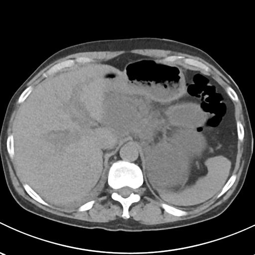 File:Acute pancreatitis and walled-off necrosis (Radiopaedia 29888-30404 Axial non-contrast 16).jpg