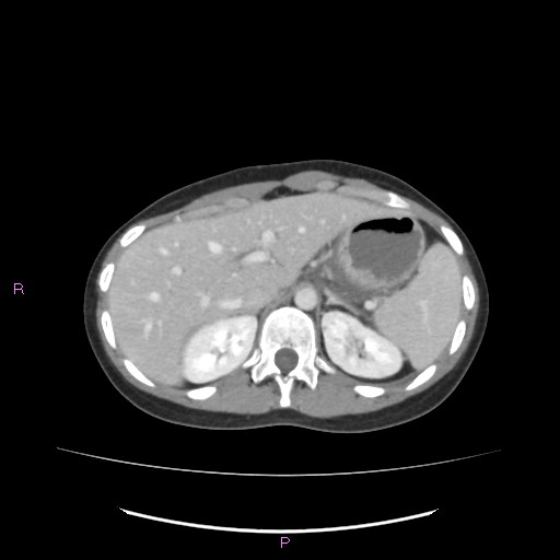 Acute pancreatitis secondary to stone at minor papilla and pancreatic divisum (Radiopaedia 76570-88333 Axial C+ portal venous phase 19).jpg
