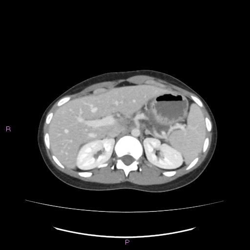 Acute pancreatitis secondary to stone at minor papilla and pancreatic divisum (Radiopaedia 76570-88333 Axial C+ portal venous phase 21).jpg