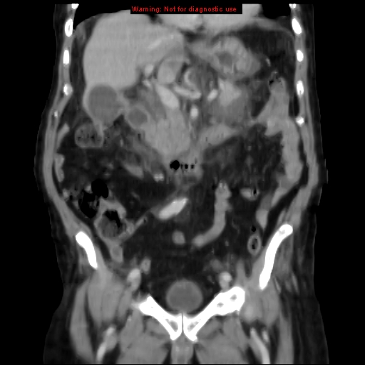 Acute pancreatitis with incidental pancreatic lipoma (Radiopaedia 10190-10730 Coronal C+ portal venous phase 30).jpg