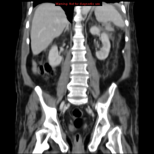 Acute pancreatitis with incidental pancreatic lipoma (Radiopaedia 10190-10730 Coronal C+ portal venous phase 47).jpg