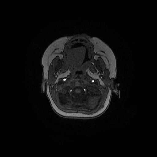 Acute phase of hemiconvulsion-hemiplegia epilepsy syndrome (Radiopaedia 29309-29745 Axial TOF angiography 154).jpg