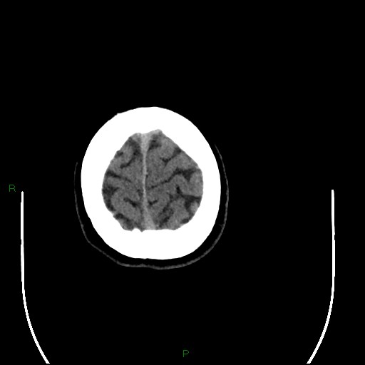 Acute posterior cerebral artery territory infarct (Radiopaedia 79329-92393 Axial non-contrast 103).jpg