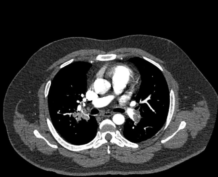 Acute pulmonary embolism with pulmonary infarcts (Radiopaedia 77688-89908 Axial C+ CTPA 27).jpg