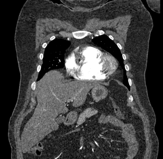 Acute pulmonary embolism with pulmonary infarcts (Radiopaedia 77688-89908 Coronal C+ CTPA 10).jpg