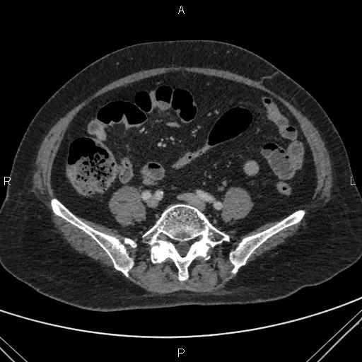 File:Acute renal artery occlusion (Radiopaedia 86586-102682 Axial C+ portal venous phase 65).jpg